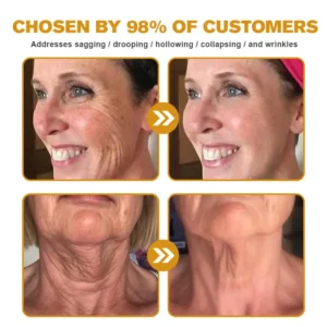 TLOPA® Botox Bee Venom Wrinkle Removal Cream