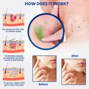 TLOPA® SUPER NatureErase Instant Mole & Spot Cream