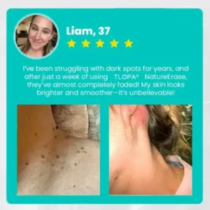 𝗧𝗟𝗢𝗣𝗔® Alligator Oil NatureErase Instant Mole & Spot Cream