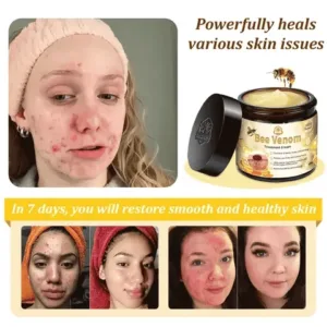 𝗧𝗟𝗢𝗣𝗔® Bee Venom Skin Treatment Cream