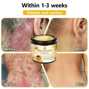𝗧𝗟𝗢𝗣𝗔® Bee Venom Skin Treatment Cream