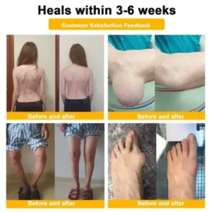 TLOPA® Botulinum Toxin & Bee Venom Pain-Relief Bone Healing Cream