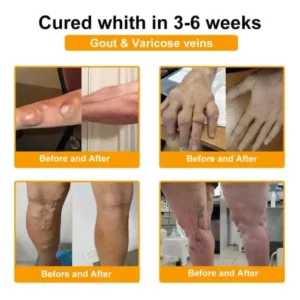 TLOPA® Botulinum Toxin & Bee Venom Pain-Relief Bone Healing Cream