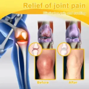 TLOPA® Botulinum Toxin & Bee Venom Pain-Relief Bone Healing Cream